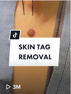 Dr Rick Skin Tag Removal